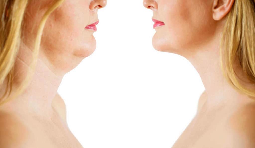 Double Chin treatment Avon before and after results