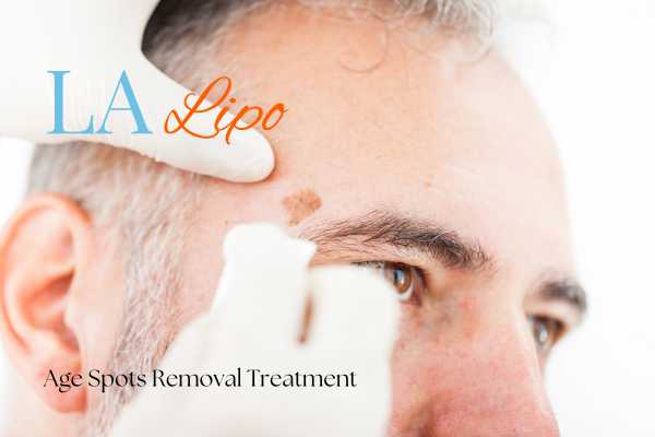 What Are the Most Effective Treatments for Age Spots Avon?