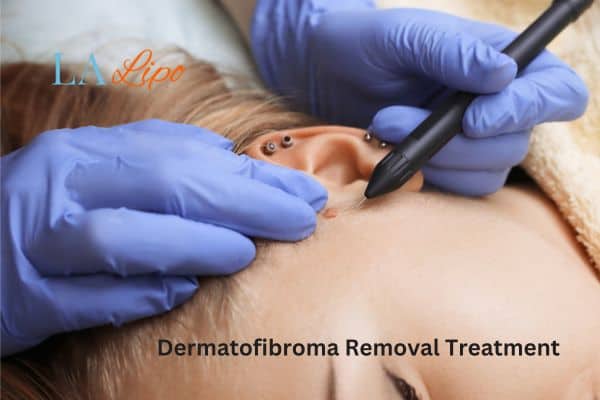 Dermatofibroma Removal Treatment Avon