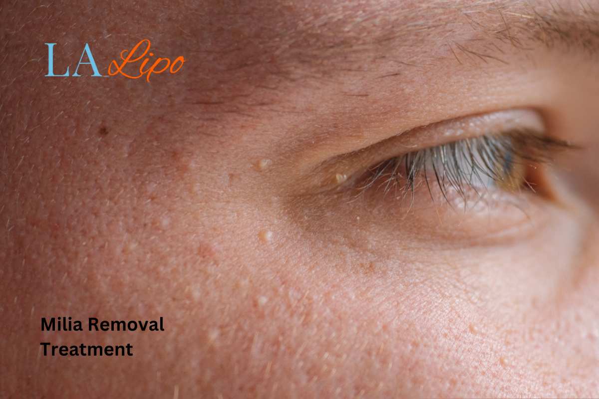 Cryopen Milia Removal: Is It the Easiest and Safest Option Avon?