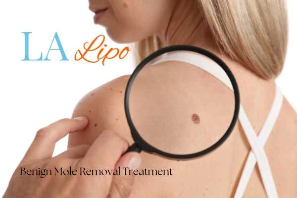 Woman having her inspection of blemish before mole removal Avon