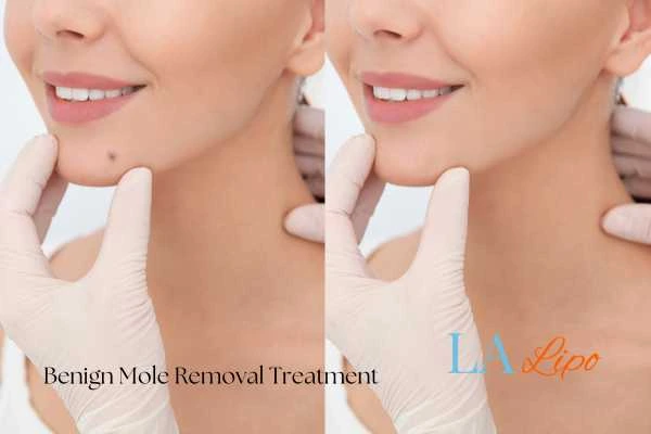 woman's before and after mole removal Avon results