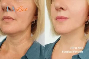hi-fu for wrinkles Avon before and after results