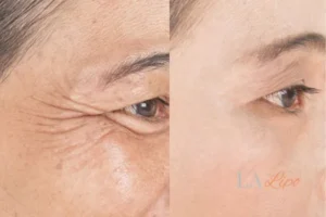 Before and after results of woman - HI-fu wrinkles reduction treatment Avon