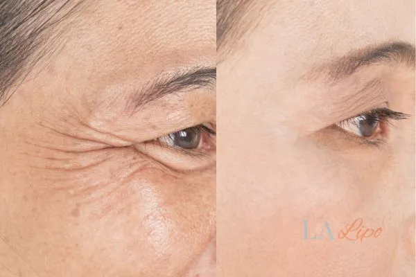 Before and after results of woman - HI-fu wrinkles reduction treatment Avon