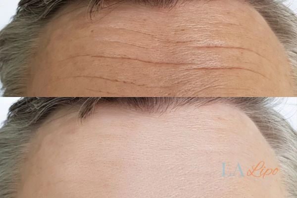 results of HIFU Avon on mans forehead to help reduce lines and wrinkles