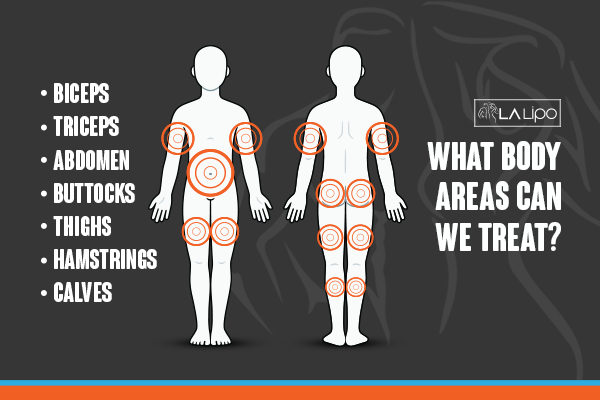 Graphic to show areas you can have LA-EMS Body Sculpting Avon treatment.