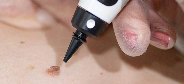 skin tag removal using cryopen Avon