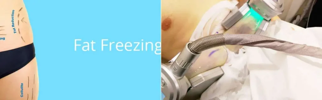 Fat freezing Avon on multiple areas of the body