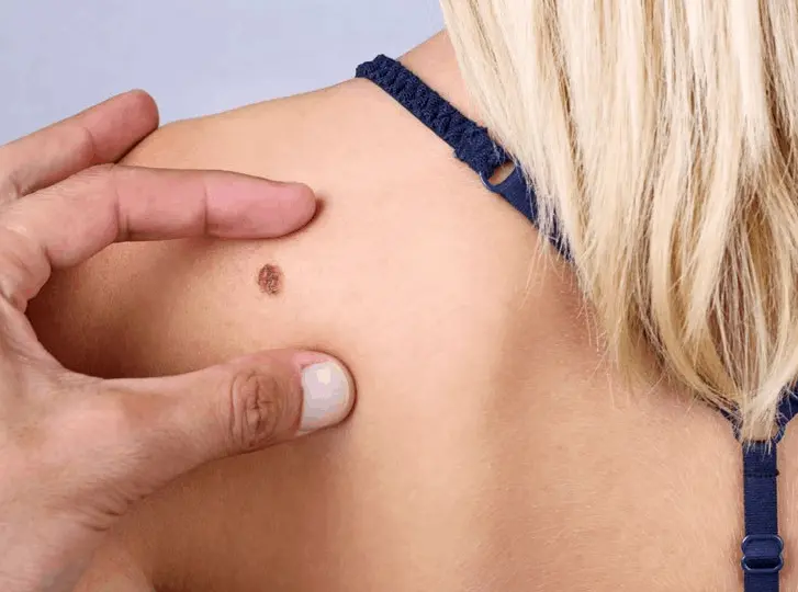 woman having mole removal Avon consultation before treatment.