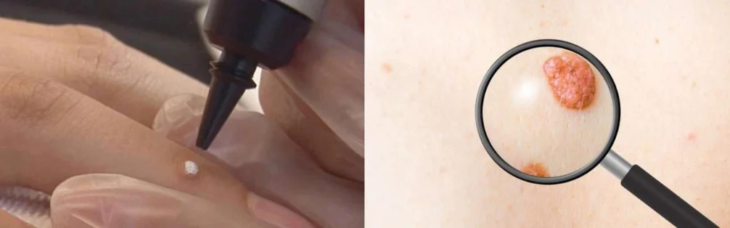 CryoPen practitioner Avon assessing a benign mole before treatment