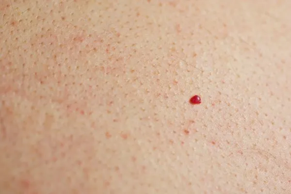 close up of a cherry angioma Avon