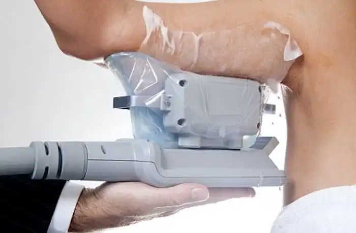 Picture of fat freezing Avon on the upper arms.