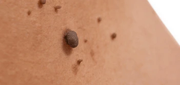 image of a skin tag Avon