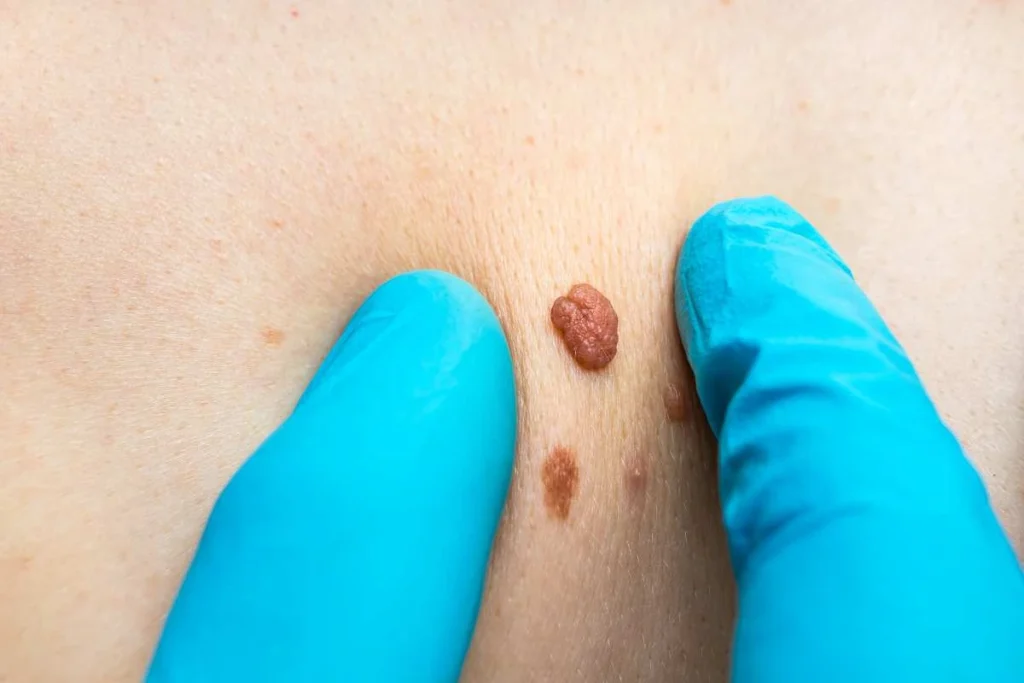 Consultant examining a skin tag Avon