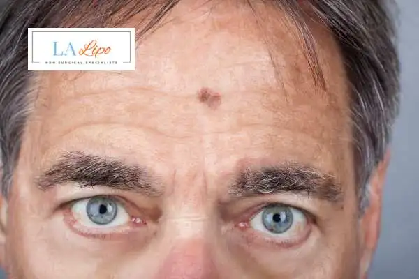 Solar Lentigo Removal Avon image of man with mark on his forehead