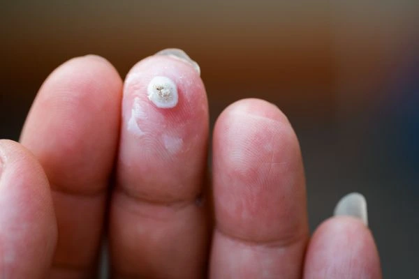 wart on person finger - cryotherapy to treat from LA LIPO Avon