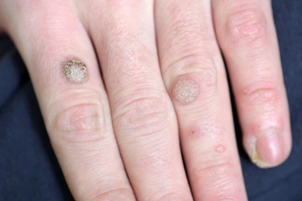 photo of warts on person hand - see wart removal Avon from LA LIPO