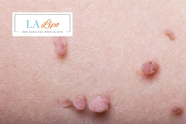 Does cryopen skin tag removal Avon hurt? Find out now call our team today!