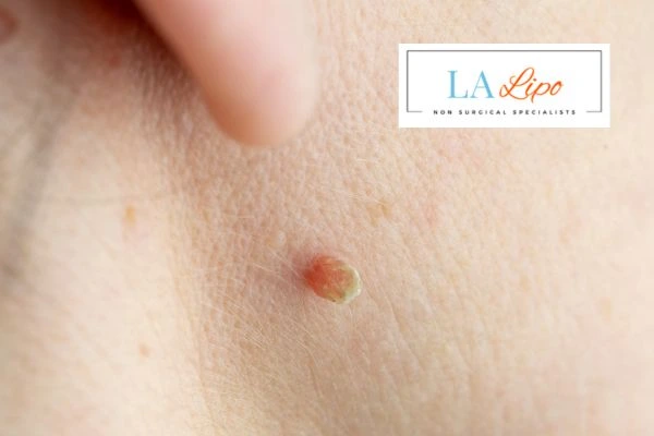 Book skin tag removal Avon today speak to our team now!