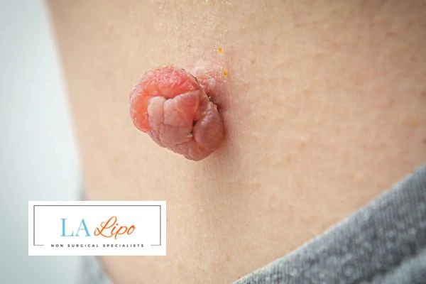 Interested in skin tag removal Avon? Concerned about the pain? Find out more today!