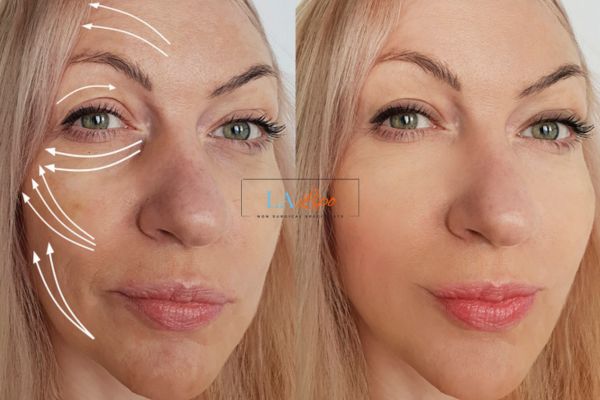 Morpheus 8 results Avon face lift.