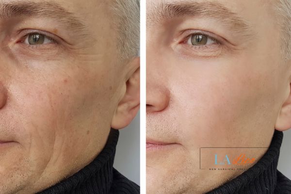 See the amazing results of Morpheus8 Treatment Avon!