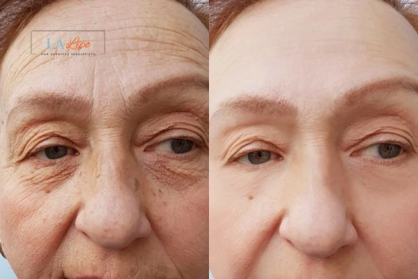 The powerful benefits of Morpheus8 Treatment Avon - Call Our team today!