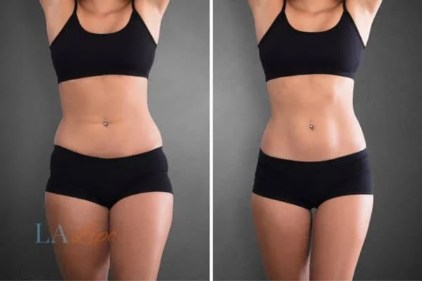 before and after results of non-surgical treatment to help a woman's body image and mental health Avon