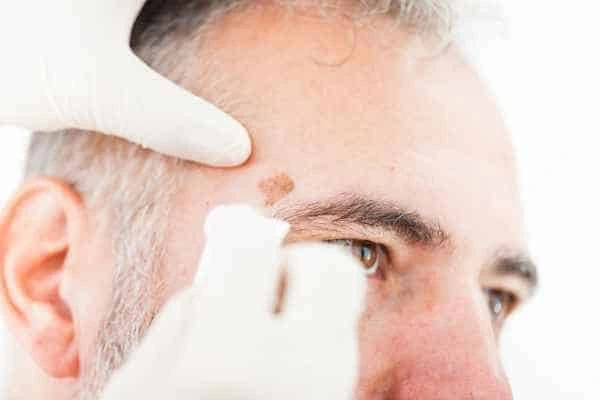 Age spots and elderly people Avon what is the link?