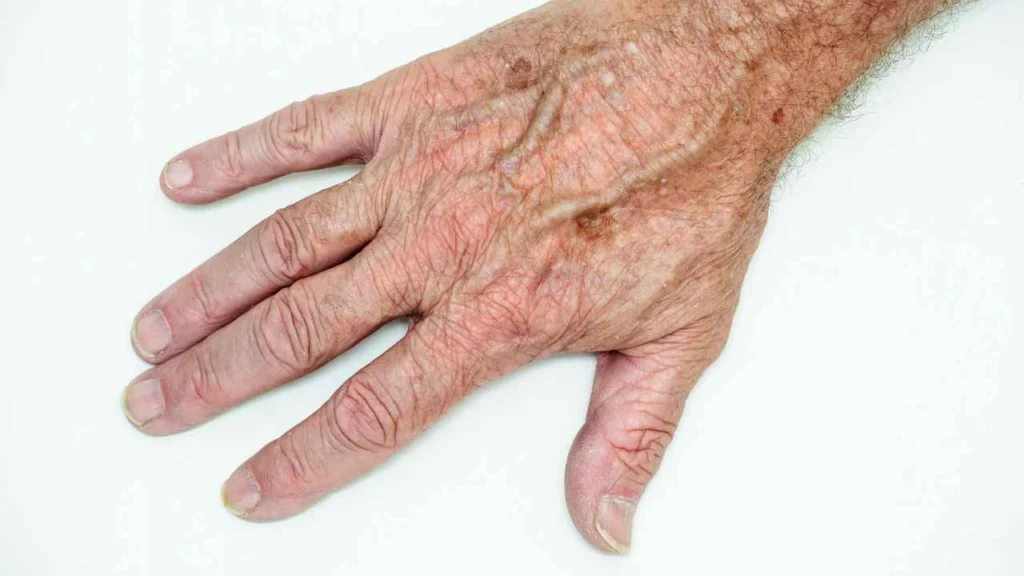 Male hand showing age spot Avon