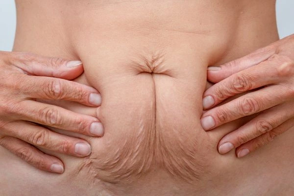 Image of a woman's stomach with loose skin - example of skin tightening Avon options