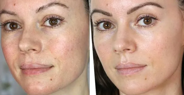 What happens during treatment Avon